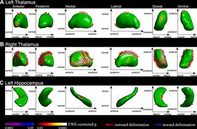 Brain Cortical Complexity and Subcortical Morphometrics in Lifelong <mark class="highlighted">Premature Ejaculation</mark>